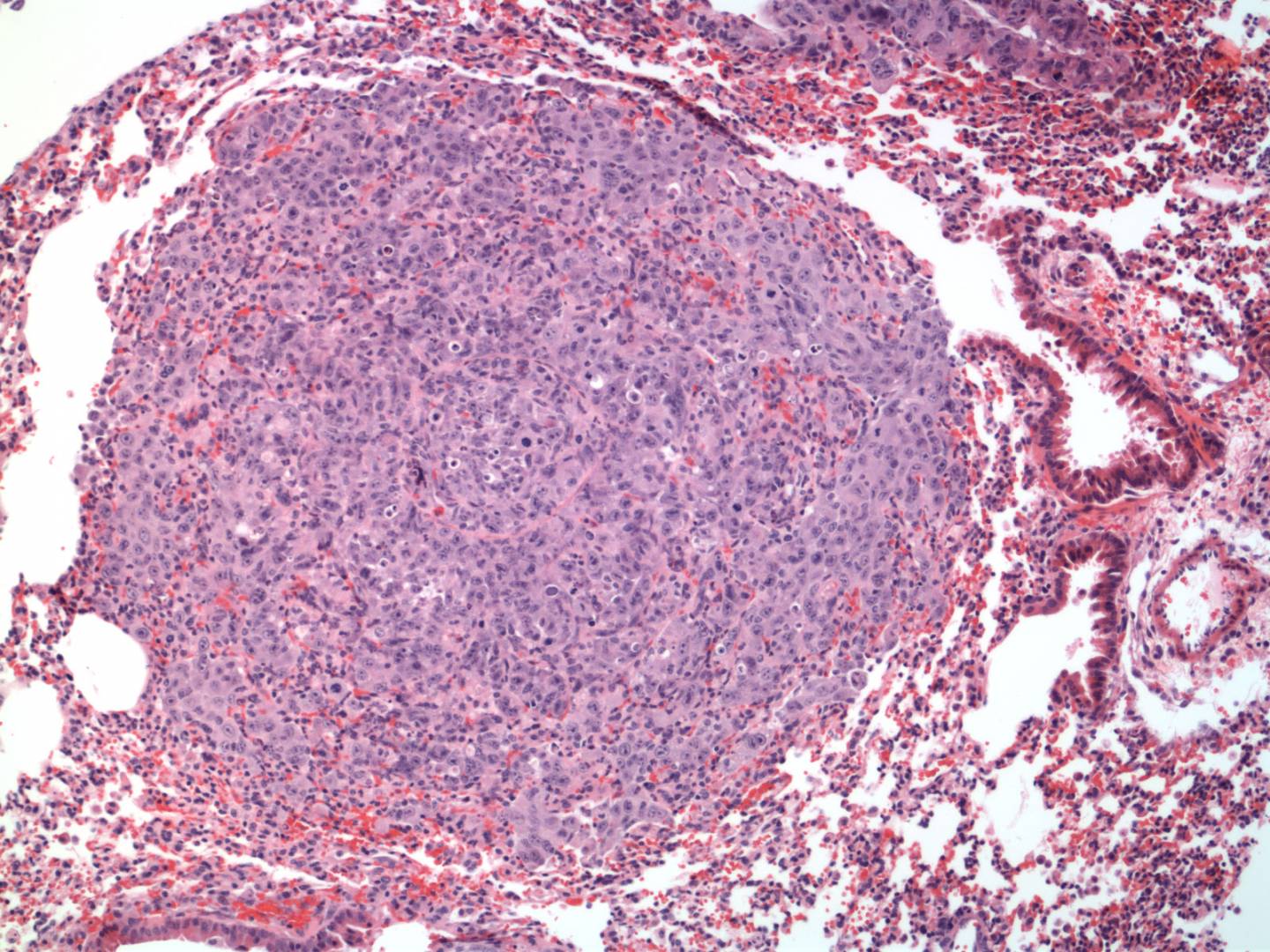 cancer cell